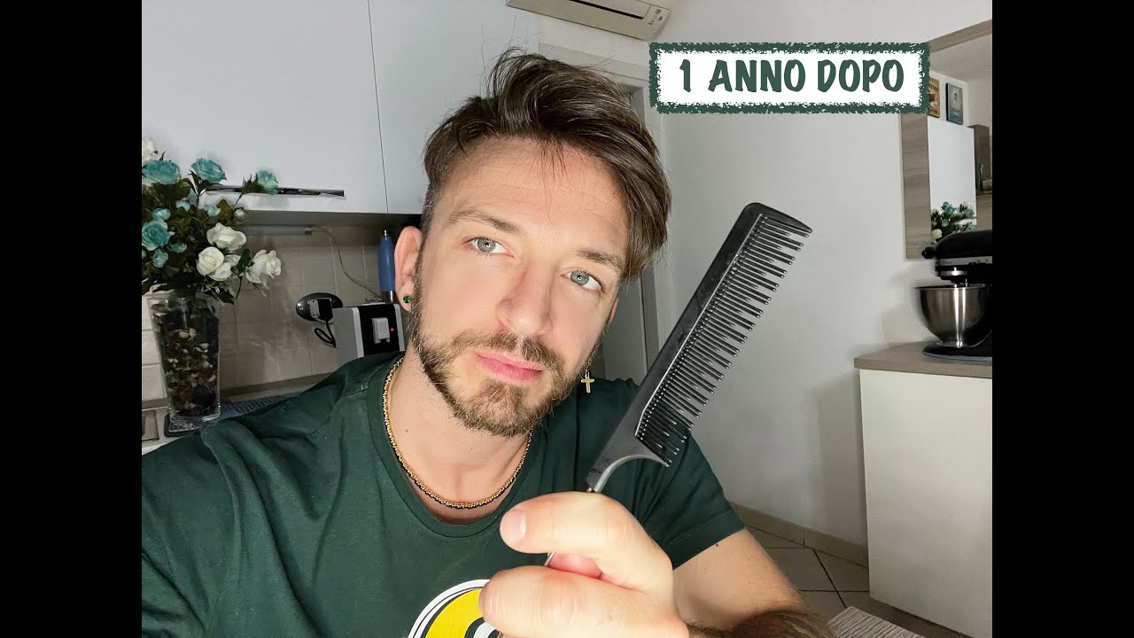 TRAPIANTO CAPELLI TURCHIA - 1 ANNO DOPO