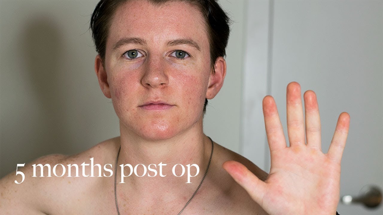 5 Months Post Top Surgery!! (FTM) | Harrison Browne