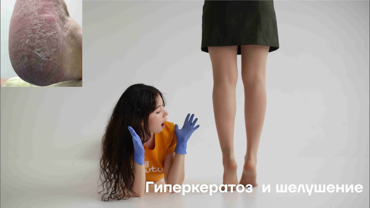 Гиперкератоз  и шелушение. О чем говорит наша кожа?