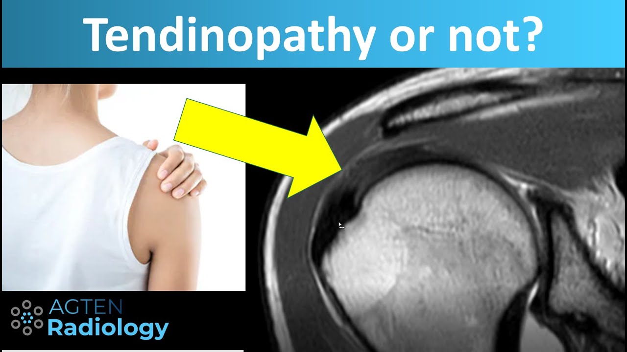 Tendinopathy (Tendinosis) of Rotator Cuff Tendons on MRI