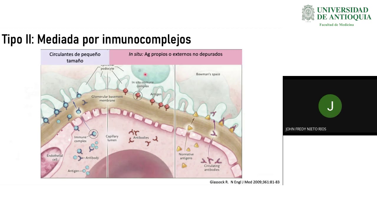 Glomerulonefritis Rápidamente Progresiva - Dra. Adriana Trejos
