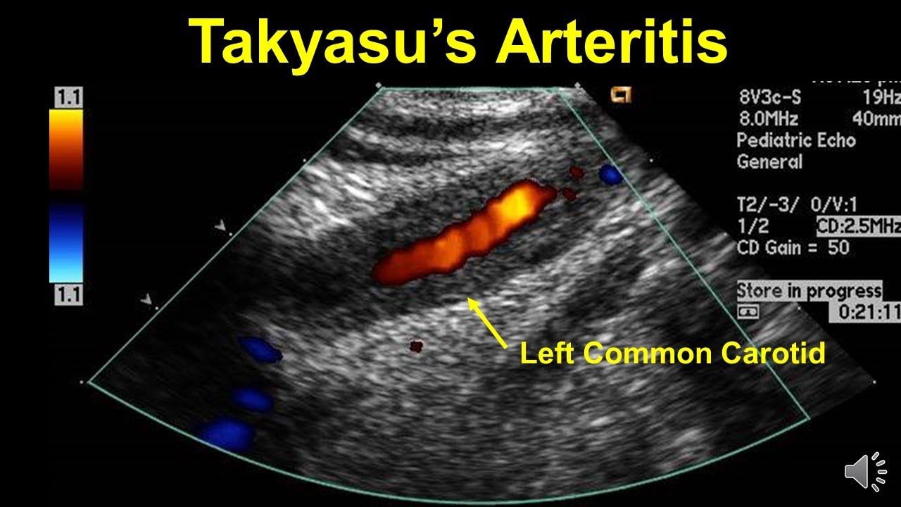 Takayasu's Arteritis: Got Pulse?