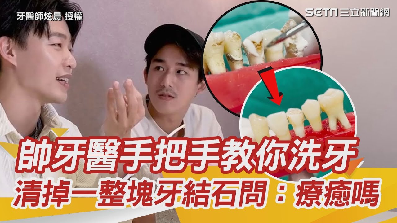 帥牙醫手把手教你洗牙　清掉一整塊牙結石喊：有療癒嗎？｜三立新聞網 SETN.com