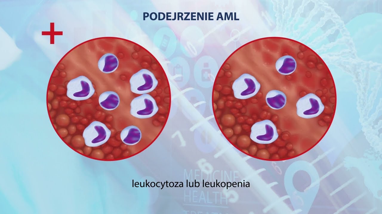 Ostra Białaczka Szpikowa AML -  przyczyny objawy diagnostyka. Sanitas.