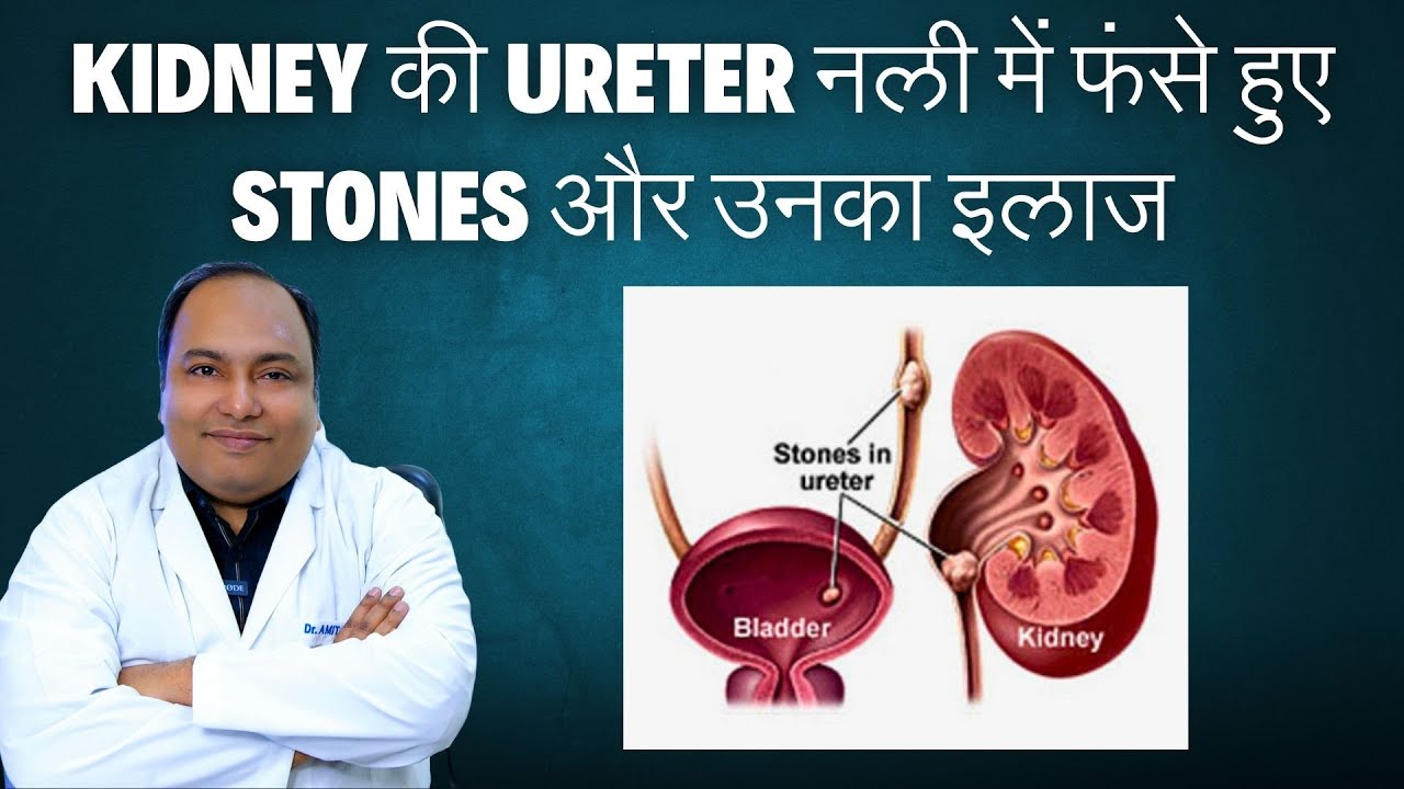 Kidney की Ureter नली में फंसे हुए stones और उनका इलाज