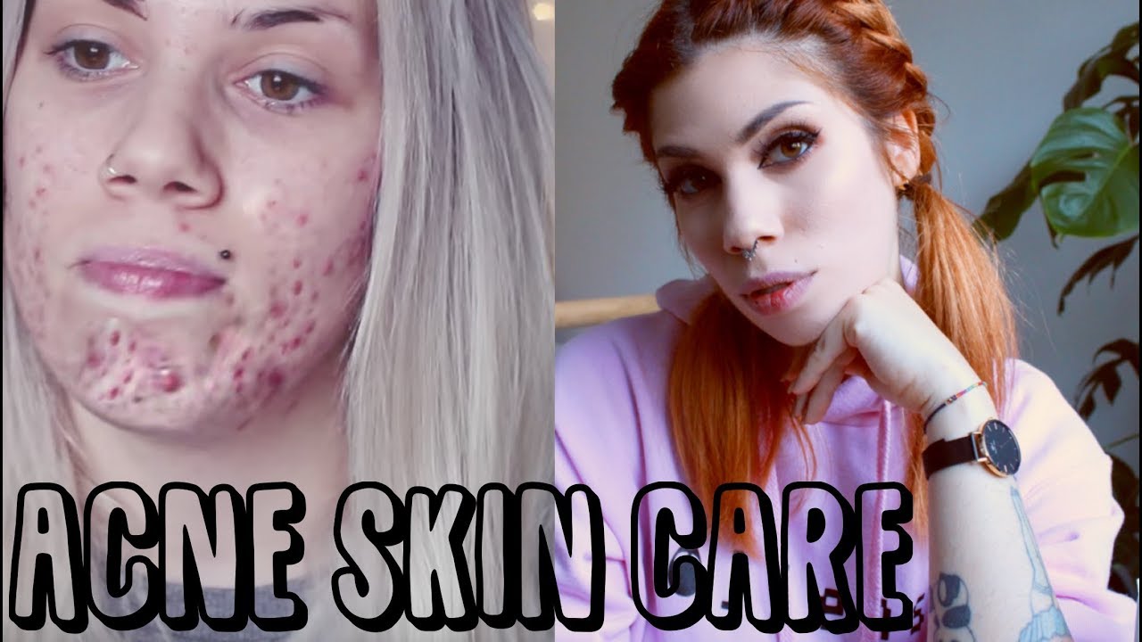 Come sono guarita dall'ACNE?! My SKIN CARE ROUTINE