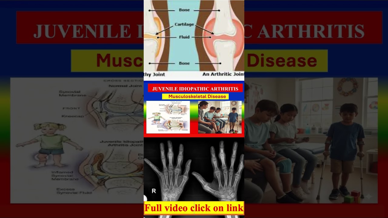 Juvenile Idiopathic Arthritis (JIA) Signs and Symptoms #medicalknowledgeonline #diagnosis #anatomy