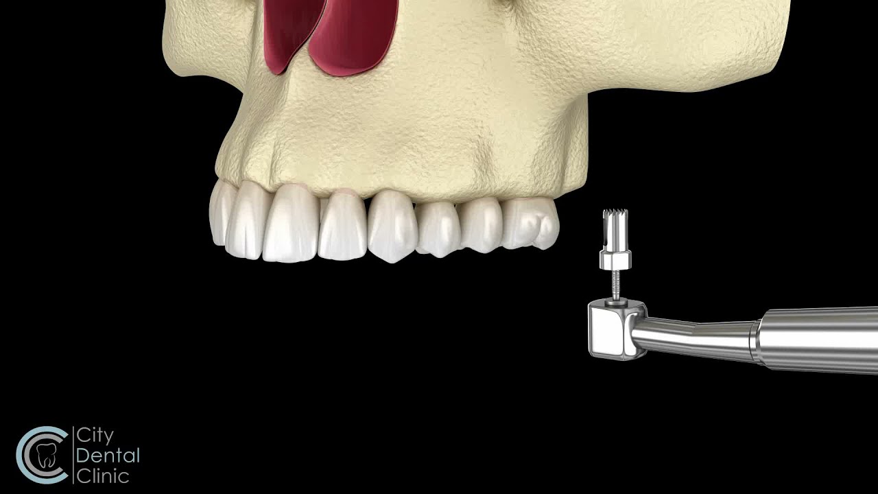 Sinus Lift - surgery before dental implant placement