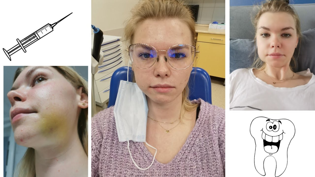 ZABIEG CHIRURGICZNY | USUWAM DOLNĄ ÓSEMKĘ 😱🤒 RELACJA DZIEŃ PO DNIU
