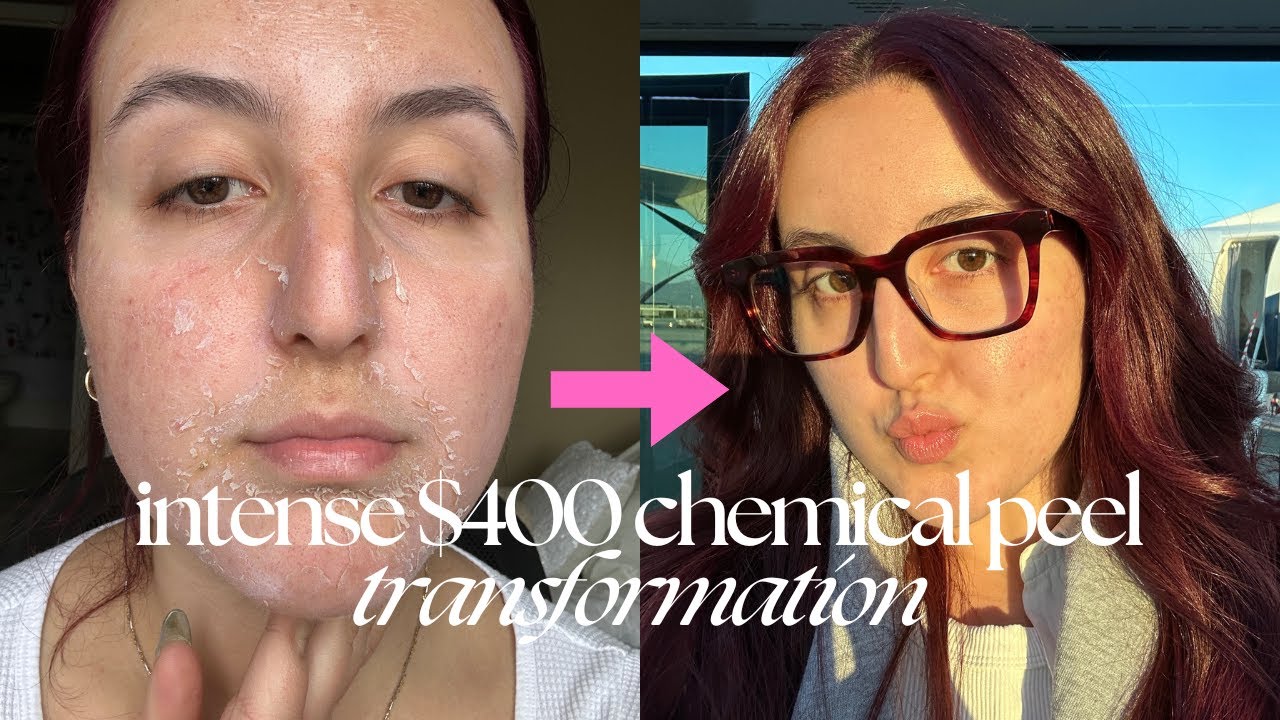 THIS WEEK WAS ROUGH: INTENSE CHEMICAL PEEL | Derma Peel Daily Updates & Honest Review