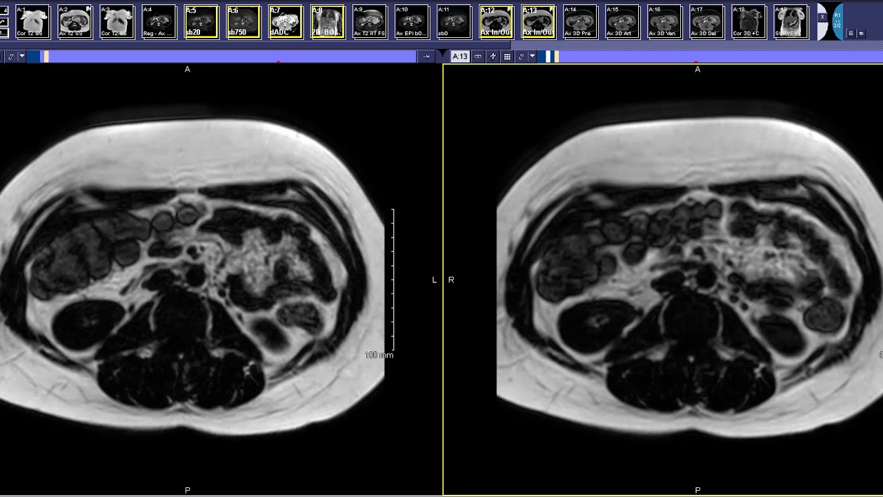 How to read a Liver MRI