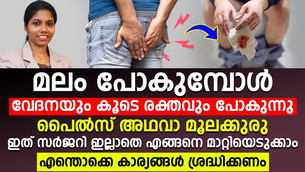 പൈൽസ് അഥവാ മൂലക്കുരു | സർജറി ഇല്ലാതെ എങ്ങനെ മാറ്റിയെടുക്കാം | ഈ കാര്യങ്ങൾ ശ്രദ്ധിച്ചു നോക്കൂ | PILES