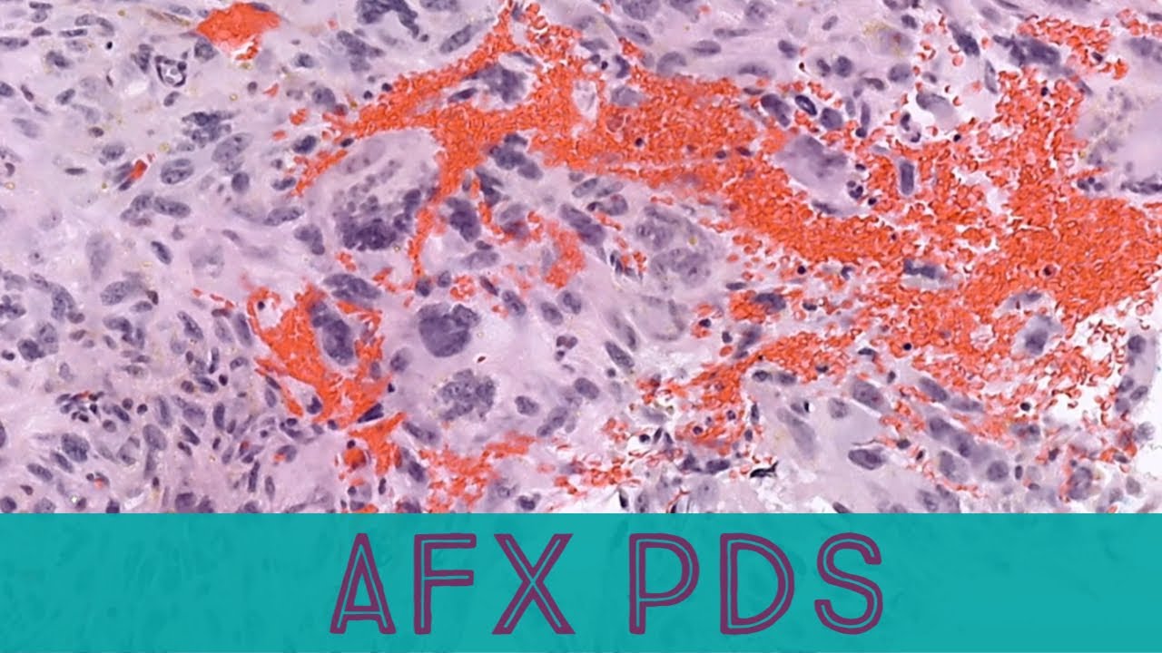 AFX & PDS (atypical fibroxanthoma & pleomorphic dermal sarcoma) (pathology dermpath dermatology)