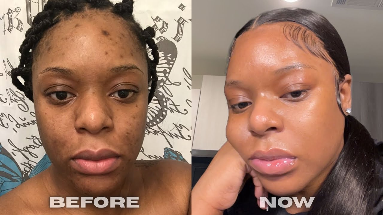 5 THINGS THAT MADE MY HYPERPIGMENTATION & DARK MARKS WORSE #hyperpigmentation