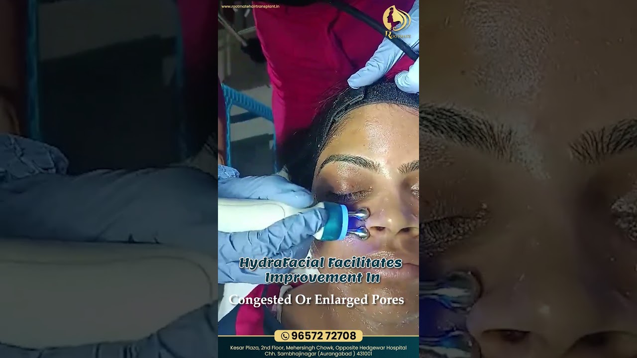 Discover the rejuvenating benefits of HydraFacial | Rootmate Hair Transplant Clinic 