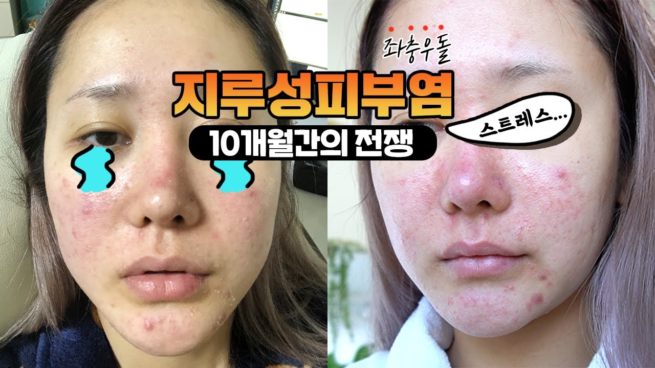 지루성 피부염으로 고생한 10개월간의 기록😂