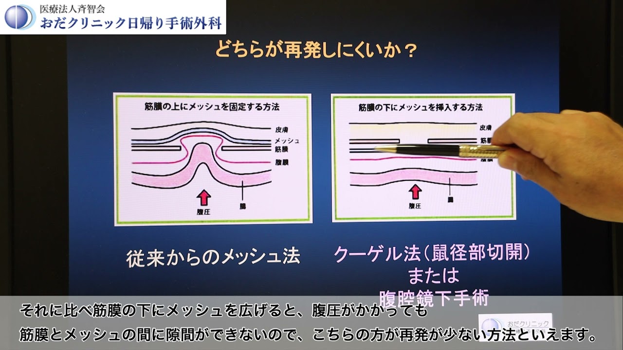 成人鼠径ヘルニアの手術について | おだクリニック日帰り手術外科(福岡市中央区)
