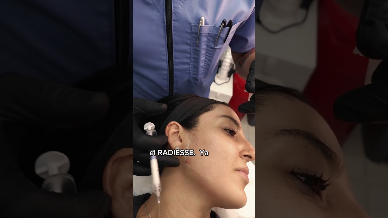 Redensificación y perfilado facial con Hidroxiapatita de calcio, Radiesse