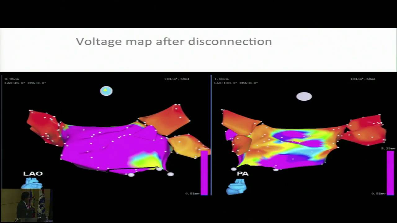 Casos editados: Aislamiento de venas pulmonares usando sistema mapeo 3D Dr. Manuel Patete
