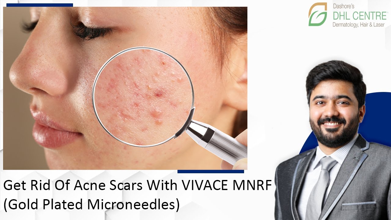 Get Rid Of Acne Scars With VIVACE MNRF (Gold Plated Microneedles) At DHL Skin Centre Indore