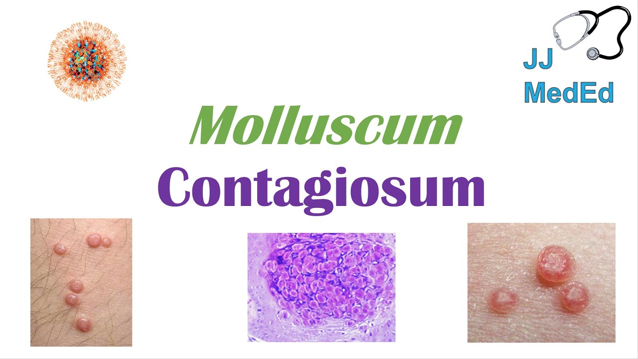 Molluscum Contagiosum (&ldquo;Papules with Belly Buttons&rdquo;): Risk factors, Symptoms, Diagnosis,  Treatment