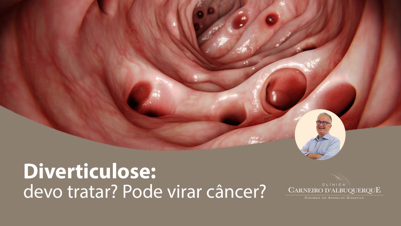 Diverticulose: devo tratar? Pode virar c&acirc;ncer? | Prof. Dr. Luiz Carneiro CRM 22761