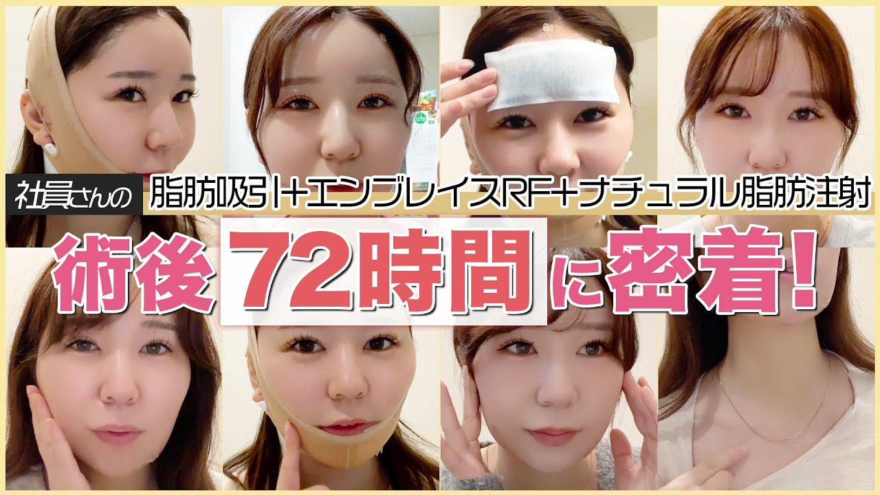【リアルレポート】みんなが不安な《術後７２時間に密着》！！SBC社員さんの【脂肪吸引＋エンブレイスRF＋ナチュラル脂肪注射】
