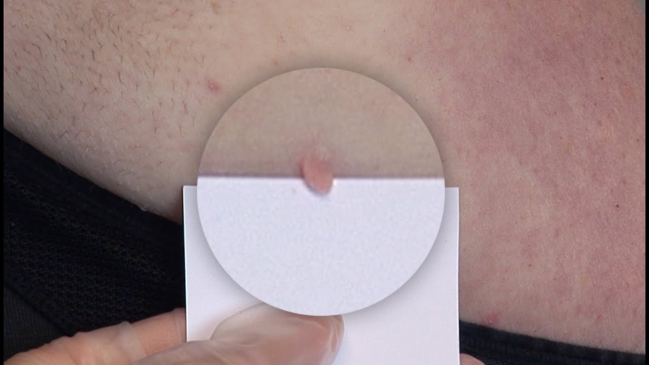 Treatment of Fibroma