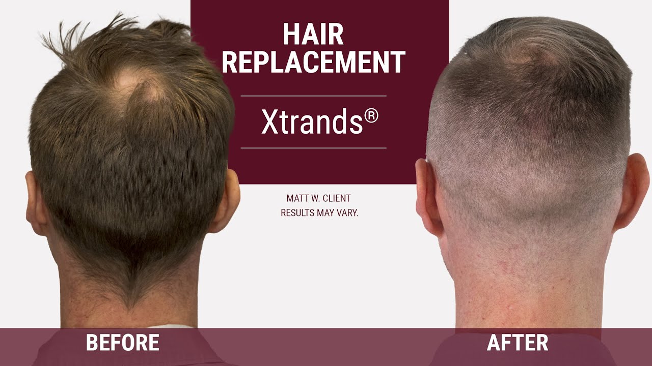 How to cover a bald spot on the back of your head [Hair Replacement]