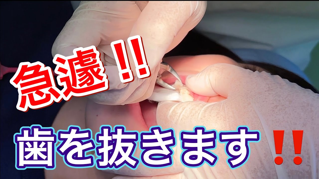 ドキドキ🥺急遽❗️歯を抜いてもらいます🦷