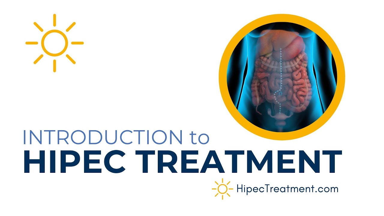 Intro to HIPEC Treatment | HipecTreatment.com