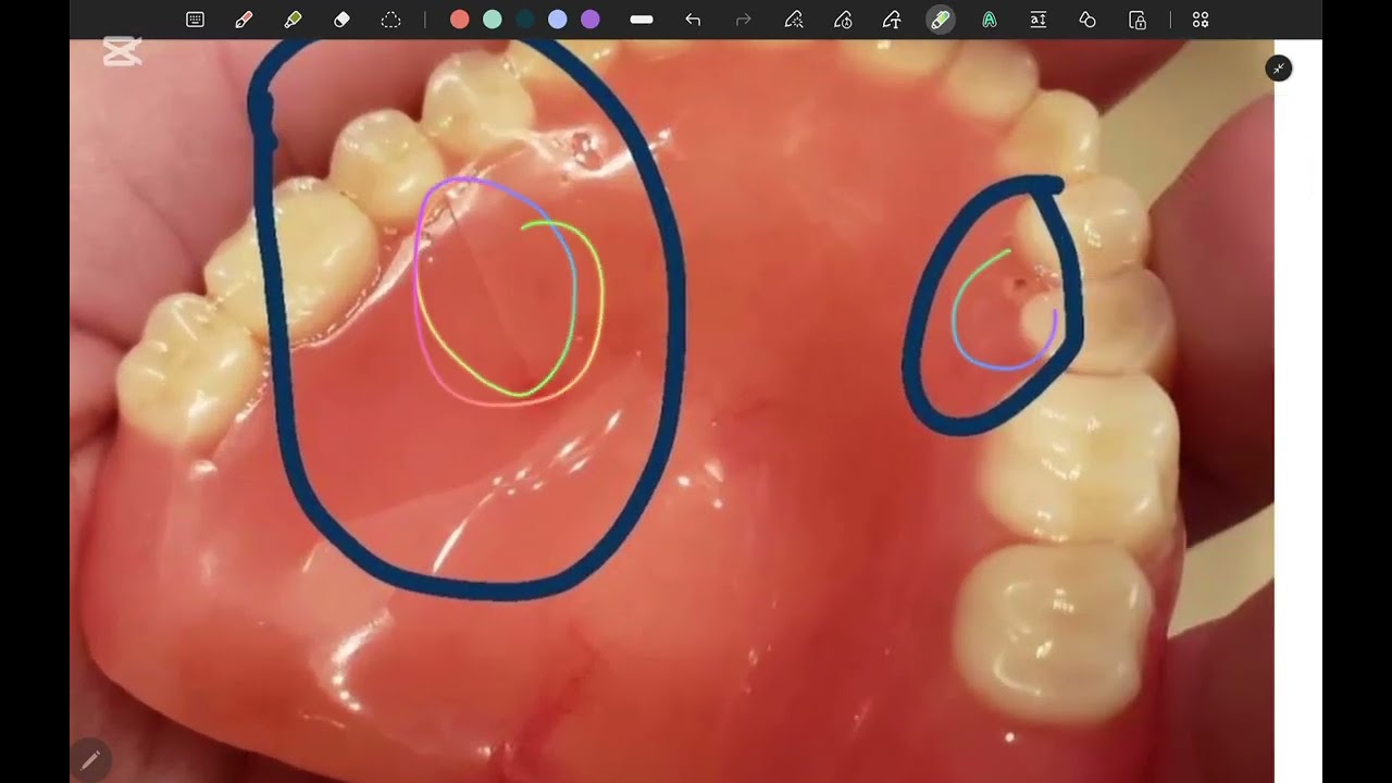 Complications in complete denture |pros|fifth stage P2 