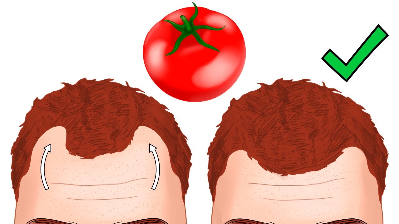 DETENER LA CA&Iacute;DA DEL CABELLO con estos 10 alimentos bloqueadores de DHT (dihidrotestosterona)