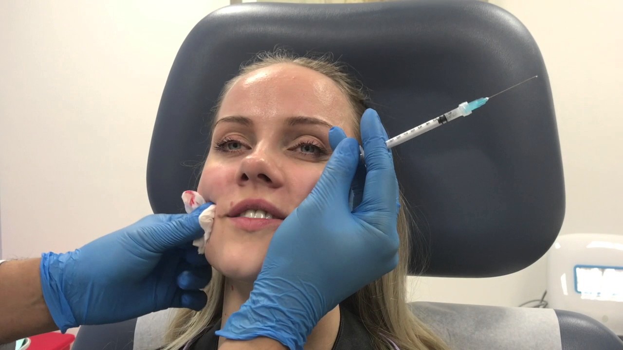 Sculptra filler treatment for cheeks, nasolabial folds, and temples by Dr. Shaun Patel in Miami, FL
