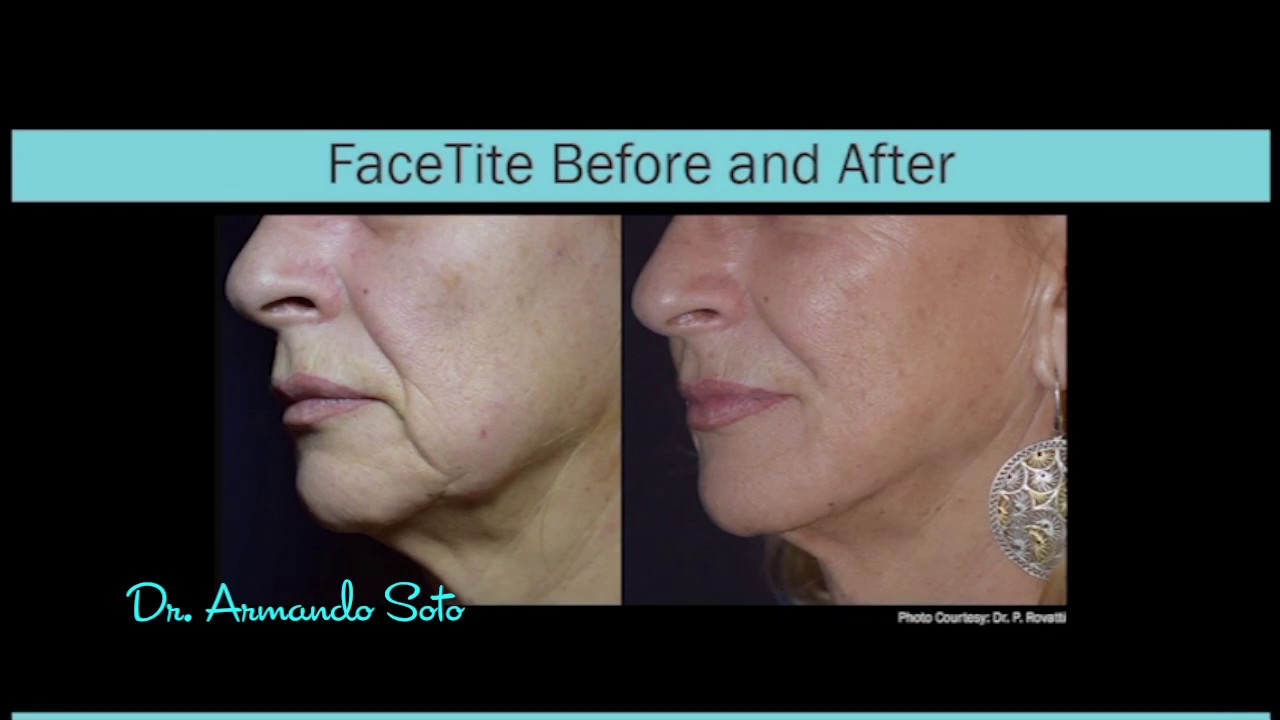 Facetite