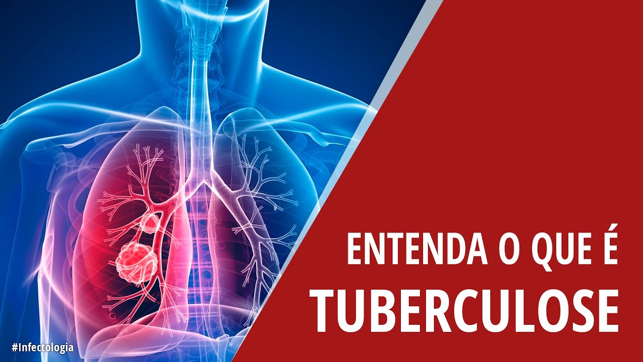 Entenda o que é Tuberculose