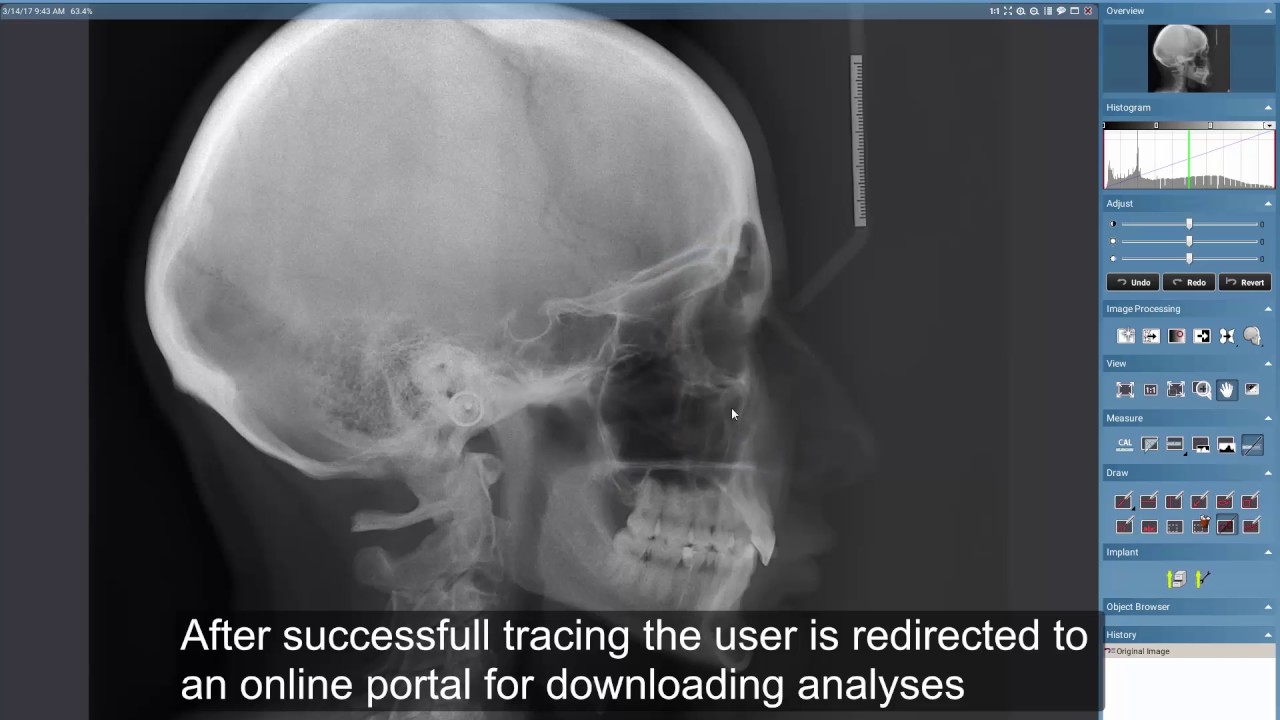 Planmeca Romexis automatic cephalometric analysis service