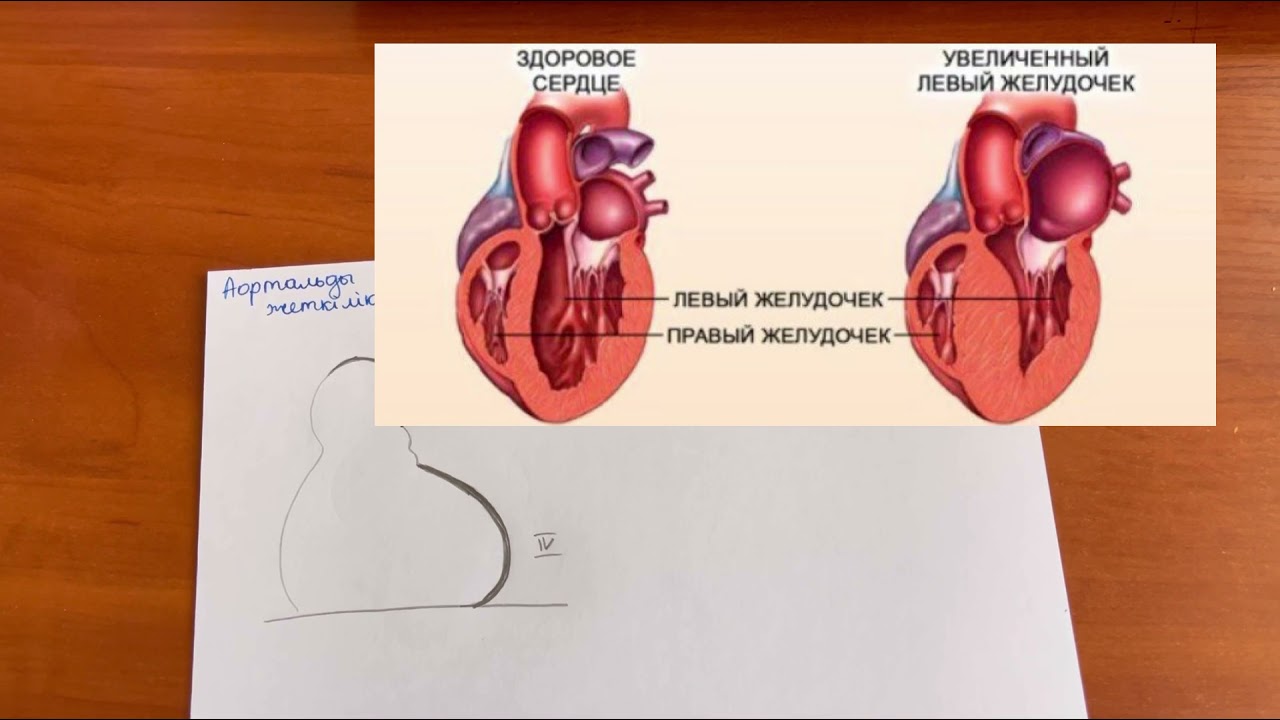Қолқаның және митральды қақпақшалардың жеткіліксіздігі мен стенозы. Рентгенді оңай түсініп ал!