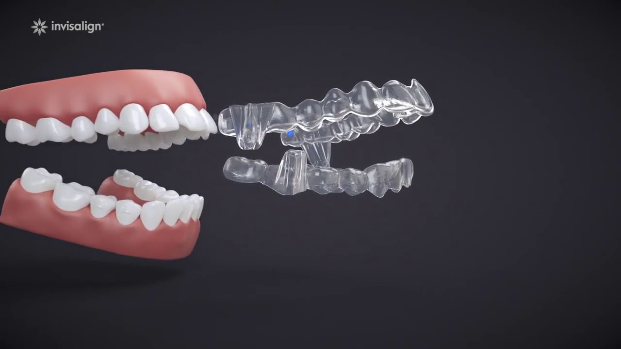 Avanço Mandibular com Invisalign - Inovação para Classe II