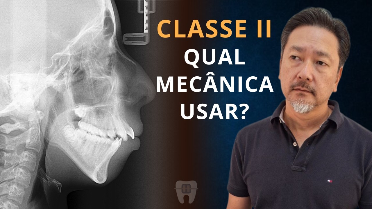 Distalizar, Extrair ou Avanço Mandibular? Como Decidir na Classe II #15