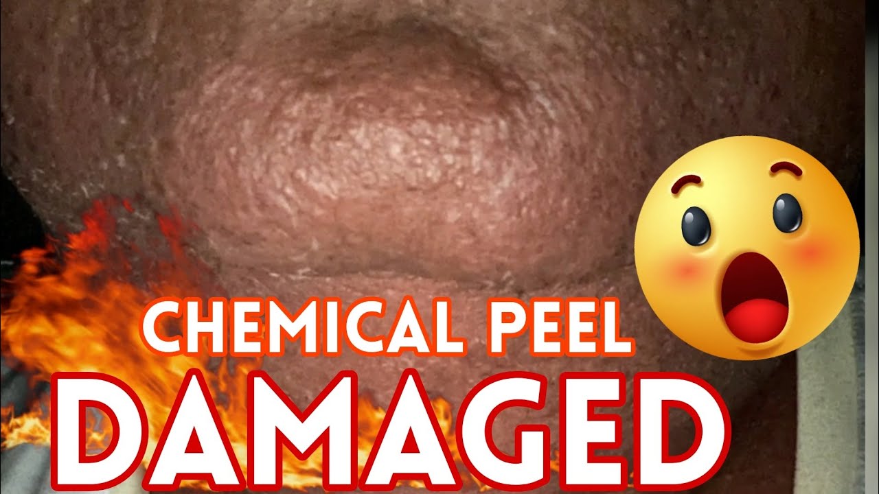 TCA Chemical Peel: Did I REALLY Do Damage To Her Skin?!! 😱 Hello Glow Peel Series Phase III
