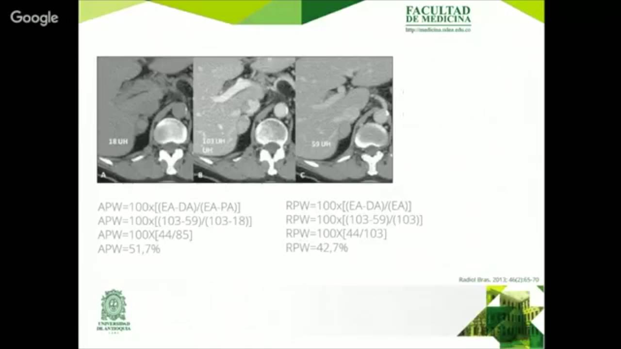 Enfoque del Paciente con un Incidentaloma Adrenal