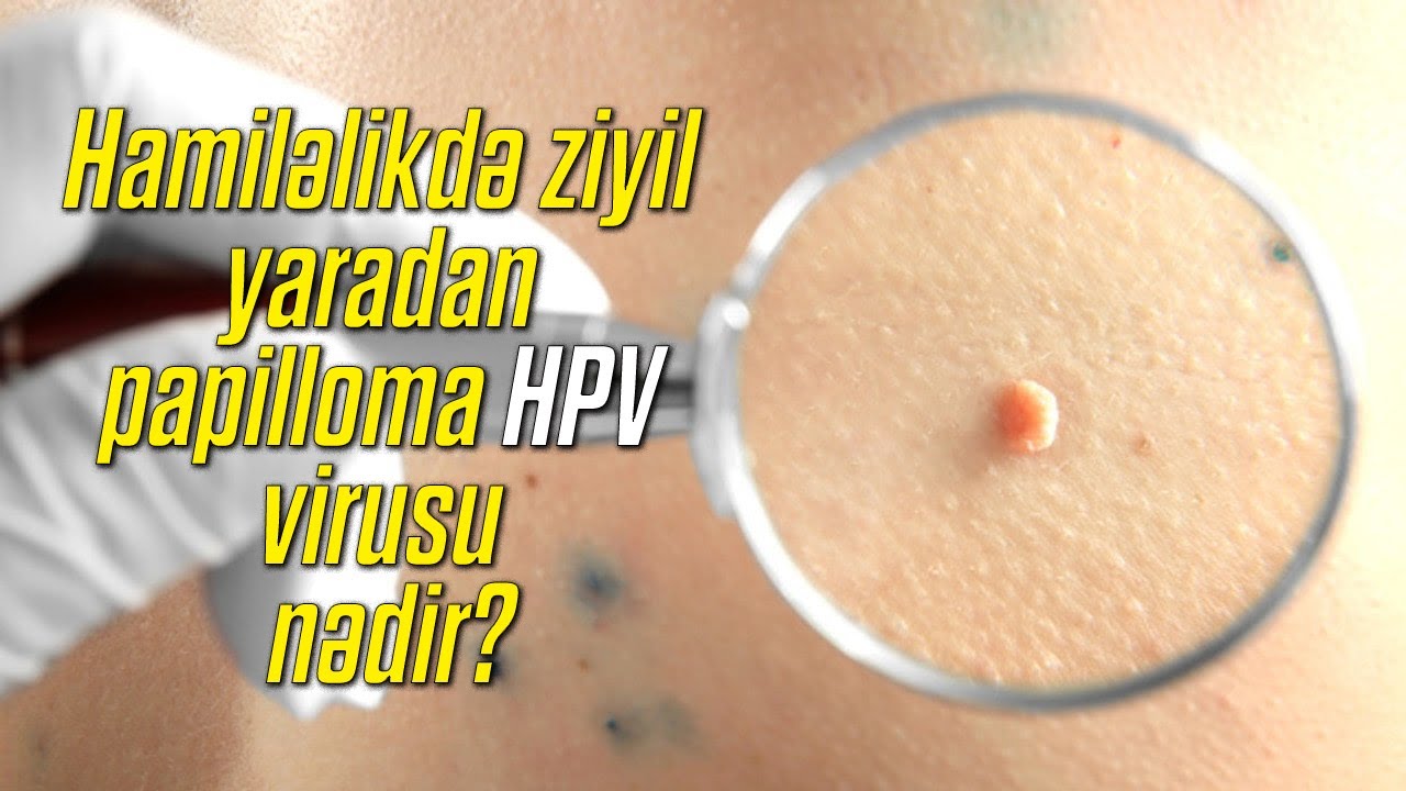 Hamiləlikdə ziyil yaradan papilloma ( HPV virusu ) nədir?