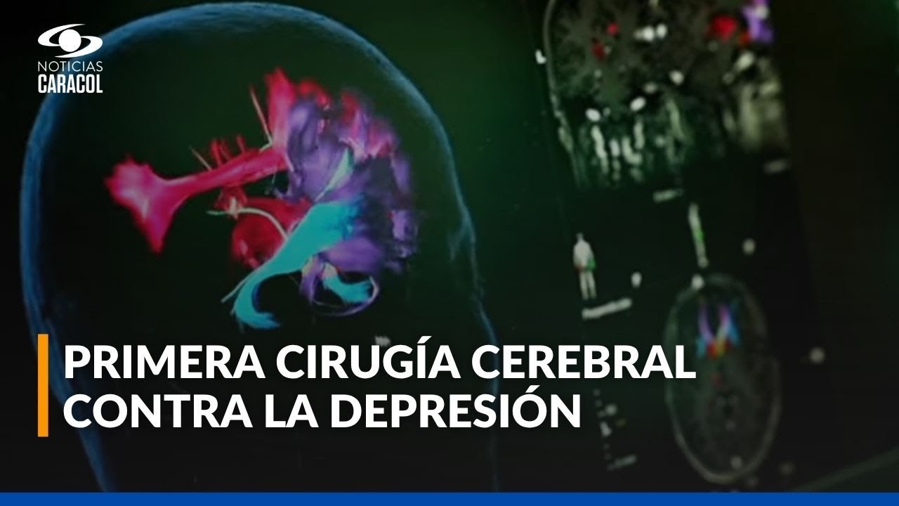 Primera cirugía cerebral contra la depresión en Colombia: así cambió la vida de una paciente