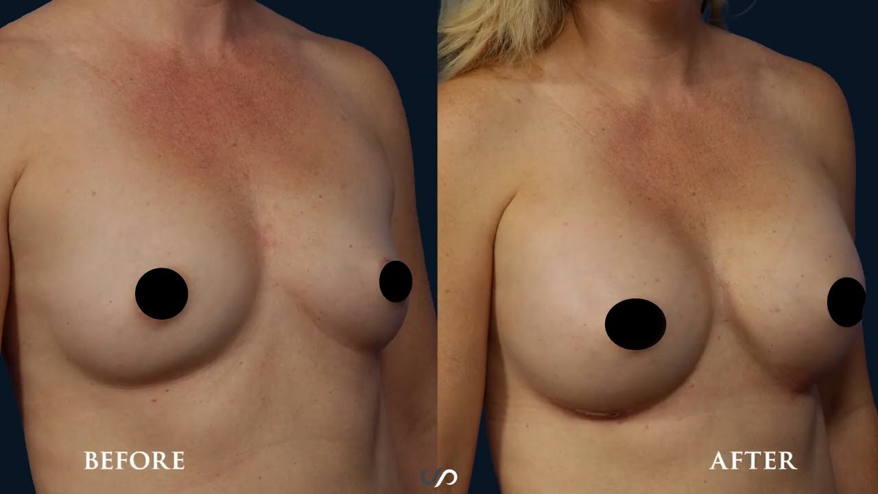 L.A. Natural Breast Augmentation | Before and After | Dr. David Stoker