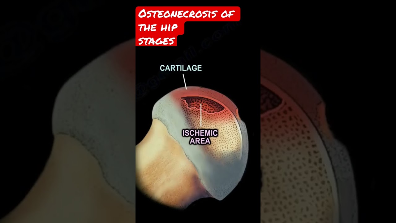 Osteonecrosis of the femoral head, stages #shorts #shorts