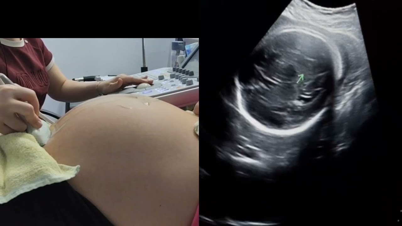 Siêu âm thai cơ bản ( đo cân nặng thai nhi)