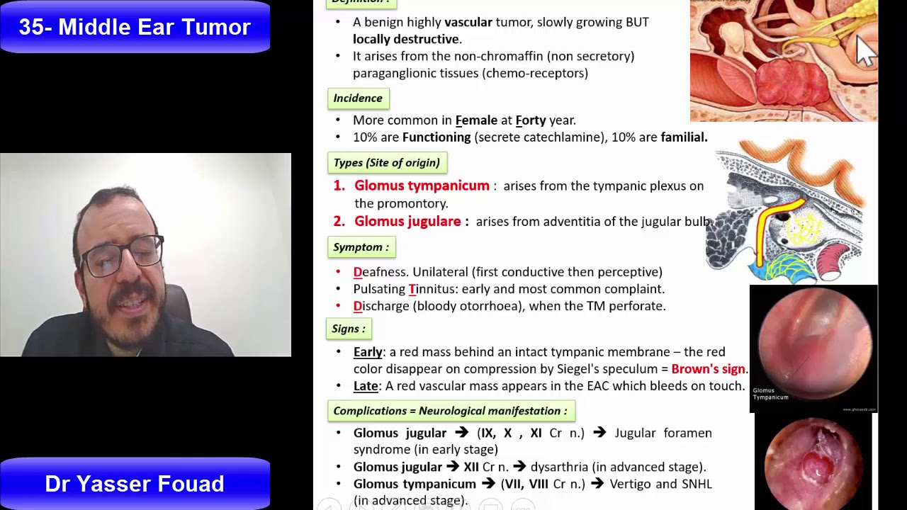 35  Middle Ear Tumor