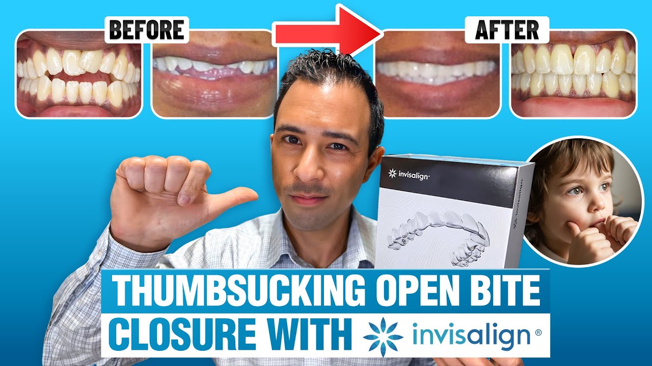 How Invisalign Fixes Thumbsucking Open Bite | Invisalign Expert Doctor | Real Patient Transformation