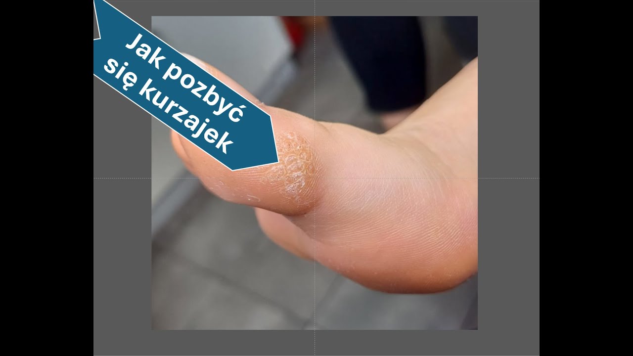 Jak pozbyć się kurzajek?